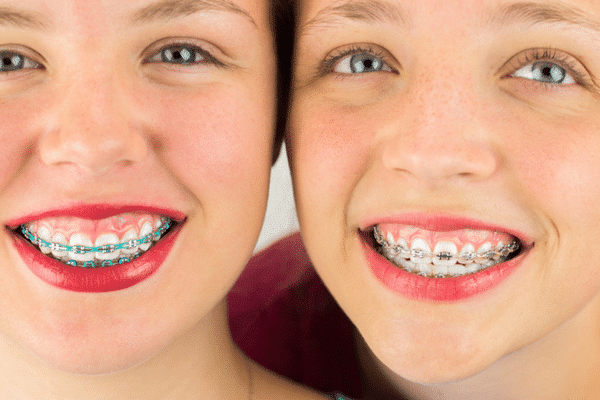 Damon Braces
