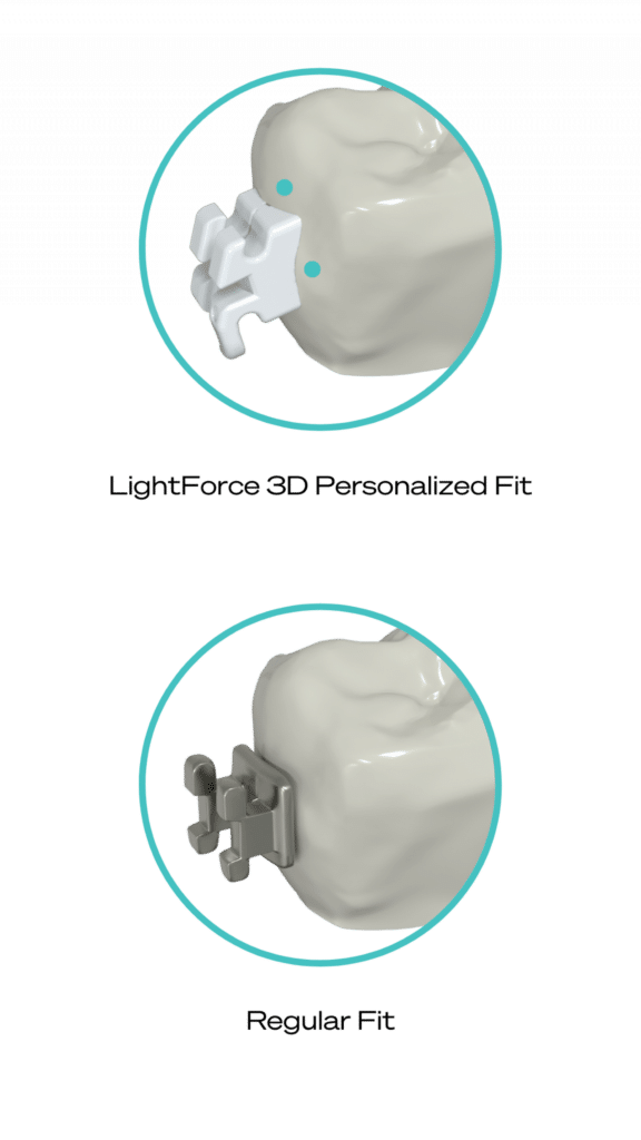 InBrace Hidden Braces